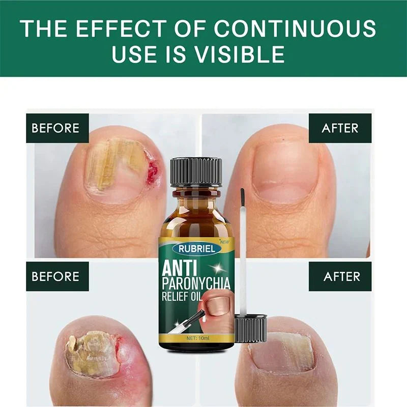 Anti Paronychia Relief Oil- Buy 1 get 1